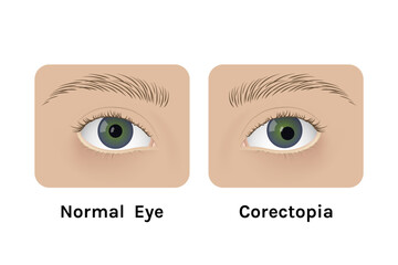 Realistic human normal eyes and with corectopia vector illustration design.