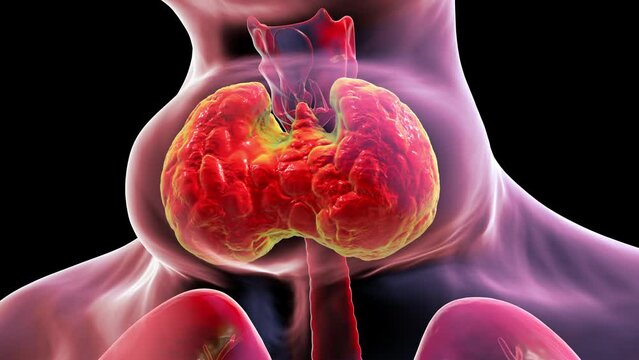 Enlarged thyroid gland, animation