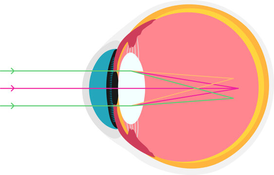 Astigmatic academic diagram structure anatomy