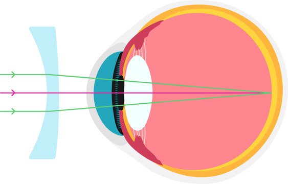 Astigmatic academic diagram structure anatomy
