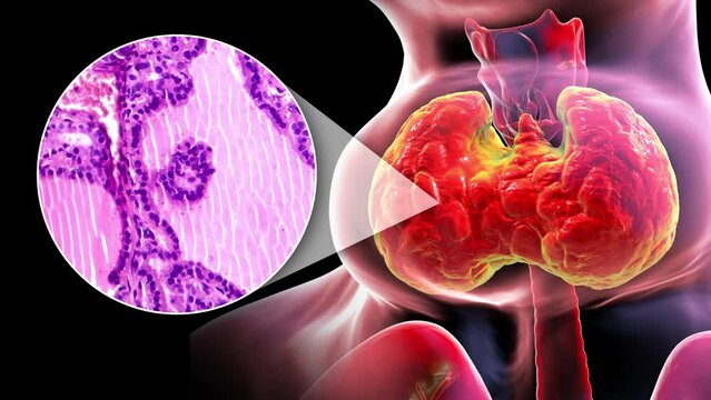 A 3D animation of a person with enlarged thyroid gland, alongside with a light micrograph footage of thyroid tissue affected by toxic goiter.