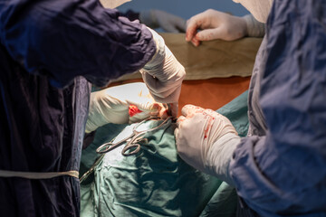 neurosurgeon , doing surgery, operation theater, subdural hematoma in the brain, multiple neurosurgeon, open brain surgery.