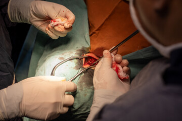 neurosurgeon , doing surgery, operation theater, subdural hematoma in the brain, multiple...