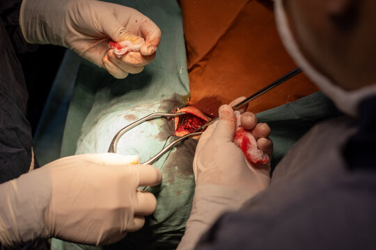 neurosurgeon , doing surgery, operation theater, subdural hematoma in the brain, multiple neurosurgeon, open brain surgery.