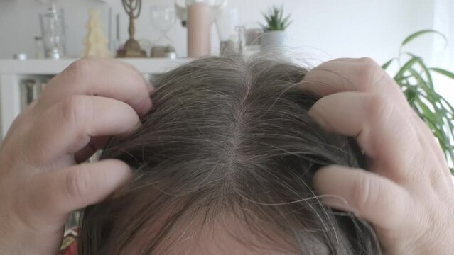woman scratching head due to dandruff, showing visible flakes on shoulders, discomfort and social impact of condition, need for treatment, flaking and itching
