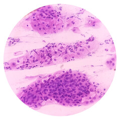 Cervical cancer cells. Atypical squamous cells of undetermined significance(ASCUS), Cancer of cervix, Pap's smear, pap's. - obrazy, fototapety, plakaty