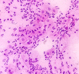 Cervical cancer cells. Atypical squamous cells of undetermined significance(ASCUS), Cancer of cervix, Pap's smear, pap's.
