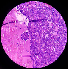 Thyroid cancer, Papillary thyroid microcarcinoma with nodular colloid goitre. Atypical thyroid...
