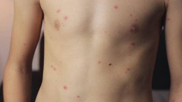 The boy's abdomen is dotted with red marks, a clear sign of chickenpox, as he battles the viral illness with discomfort and itchiness.