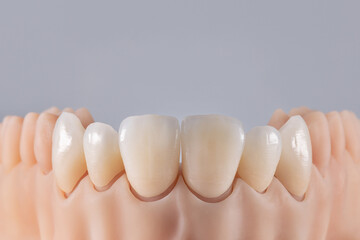 Six ceramic crowns on silicone gums. Dental model of teeth front view.