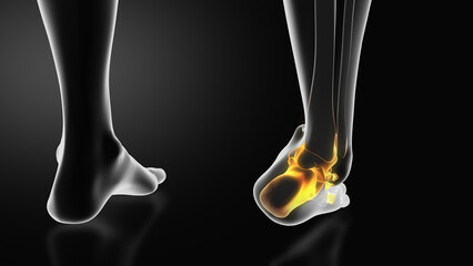 Ankle injury with dislocation and sprains - obrazy, fototapety, plakaty