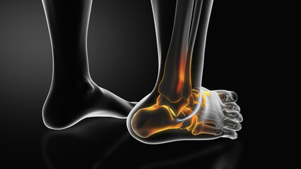 Ankle injury with dislocation and sprains