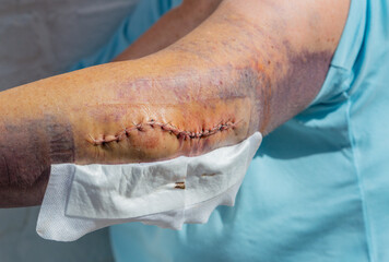 Operation Nähte und Bluterguss am Arm einer Frau nach einem Ellenbogenbruch 