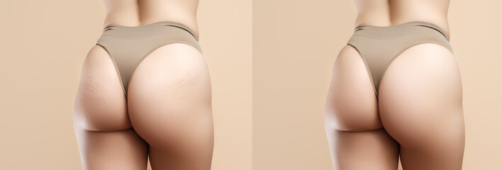 Female buttocks with stretching marks before and after treatment. demonstration of Women's hip skin...
