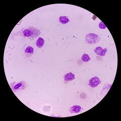 Blood cancer. Photomicrograph of Acute Myeloblastic Leukemia or AML, a cancer of white blood cell. Peripheral blood smear showing cancer cells.