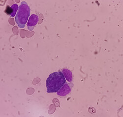 Blood cancer. Photomicrograph of Acute Myeloblastic Leukemia or AML, a cancer of white blood cell. Peripheral blood smear showing cancer cells.