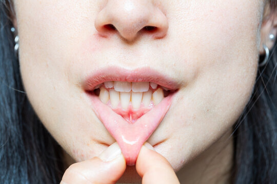Gum Recession Exposed - Close-Up of Dental Health Issue