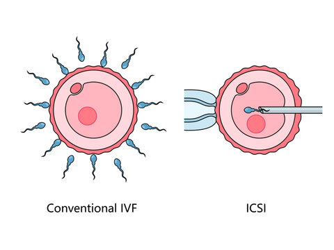 contrasting conventional In Vitro Fertilization IVF with Intracytoplasmic Sperm Injection ICSI technique hand drawn schematic vector illustration. Medical science educational illustration
