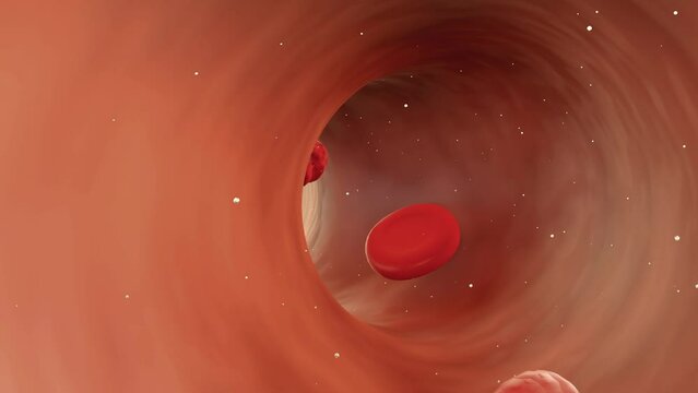 3d animation of Cardiovascular syphilis refers to the infection of the heart and related blood vessels by the syphilis bacteria