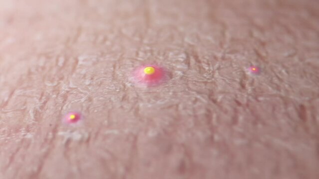 Growing pimples, acne on the skin. Macro shot, realistic 3D animation.