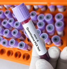 Blood sample for HHV 6(Human Herpesvirus 6) and HHV-8 test, roseola