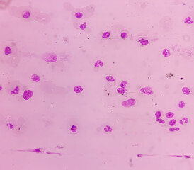 Bone marrow study, microscopically show megakaryocytes. Megakaryocytic hyperplasia....
