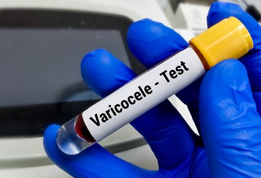 Varicocele, is the enlargement of the veins that transport oxygen-depleted blood away from the testicle.