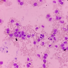 Leukemia. Photomicrograph of hematological blood slide showing neutrophilic leukocytosis with monocytosis with occasional myelocytes seen. Chronic myelomonocytic leukemia. Thrombocytopenia.