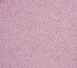 Leukemia. Photomicrograph of hematological blood slide showing neutrophilic leukocytosis with monocytosis with occasional myelocytes seen. Chronic myelomonocytic leukemia. Thrombocytopenia.