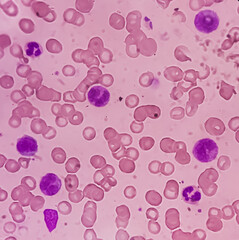 Leukemia. Photomicrograph of hematological blood slide showing neutrophilic leukocytosis with monocytosis with occasional myelocytes seen. Chronic myelomonocytic leukemia. Thrombocytopenia.