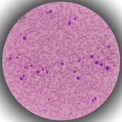 Leukemia. Photomicrograph of hematological blood slide showing neutrophilic leukocytosis with...