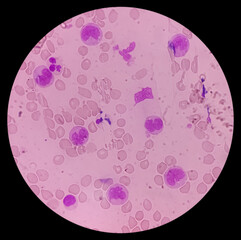Leukemia. Photomicrograph of hematological blood slide showing neutrophilic leukocytosis with...