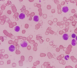 Leukemia. Photomicrograph of hematological blood slide showing neutrophilic leukocytosis with monocytosis with occasional myelocytes seen. Chronic myelomonocytic leukemia. Thrombocytopenia.