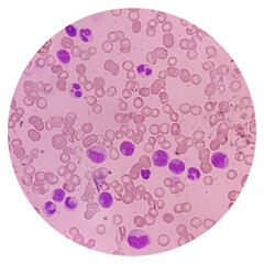 Leukemia. Photomicrograph of hematological blood slide showing neutrophilic leukocytosis with...