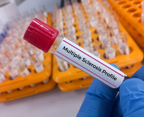 Blood sample for MS (Multiple Sclerosis) profile testing. Multiple Sclerosis disease test medical...