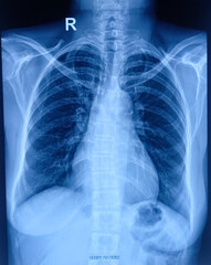 Pneumonitis(right), CXR (Chest X-Ray) PA view.
