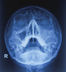 PNS X-ray OM view film, left maxillary sinusitis with hypertrophied inferior turbinates. show nose pin and ear pin.