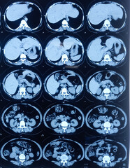 MRI (magnetic resonance imaging) of Lumbo sacral Spine. Degenerative change in lumber spine. Osteophytic change.