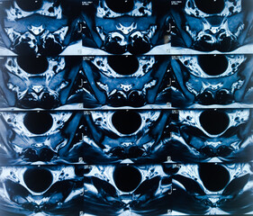 MRI (magnetic resonance imaging) of Lumbo sacral Spine. Degenerative change in lumber spine....