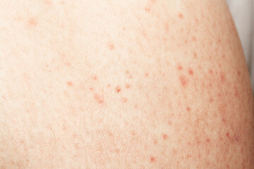 close-up of skin irritation with visible redness