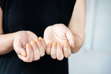 closeup woman showing yellow nail fungus caused by wearing nail polish or smoking long term