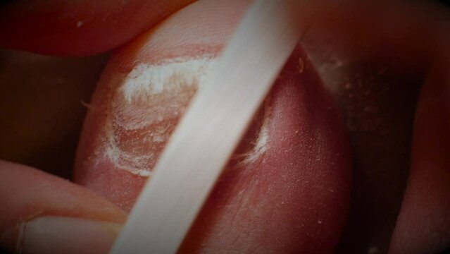 Eagerly filing down a big toe nail infected with fungus