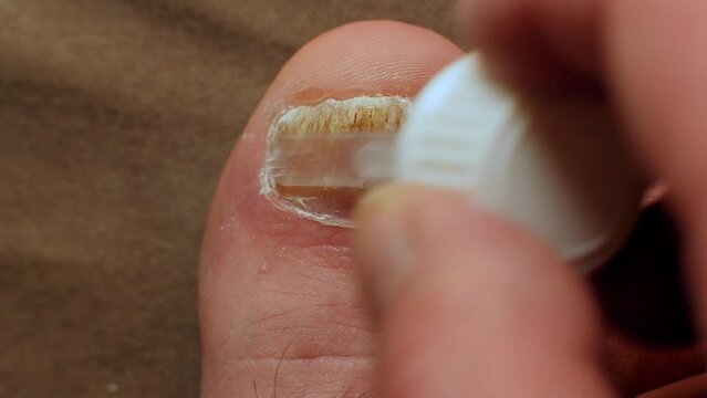 Applying potent anti-fungal medication to big toe nail