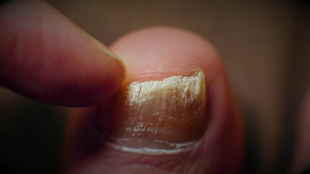 Podologist inspects big toe with fungal nail infection in macro shot