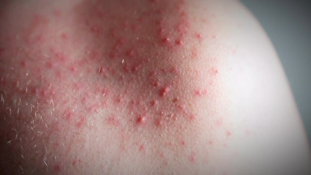Close-up shot of skin rashes and pimples on human shoulder, red itchy spots being an allergy reaction on food, medicine, stress, imbalanced hormones, cancer disease, some chemicals or unhygienic