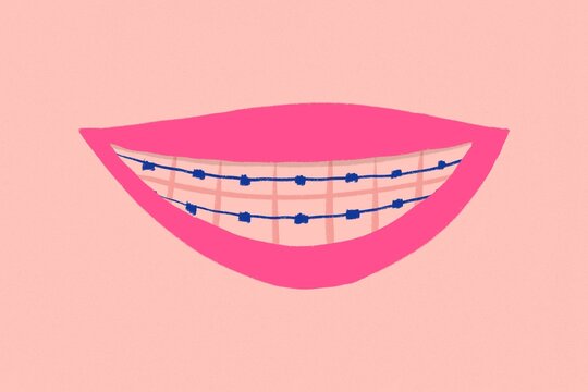 Smiling mouth with orthodontics. Dentist concept
