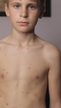 Vertical. portrait  teenage boy with red sore cover .Child seems to be afflicted with chickenpox, as indicated by characteristic red lesions, commonly associated with illness.