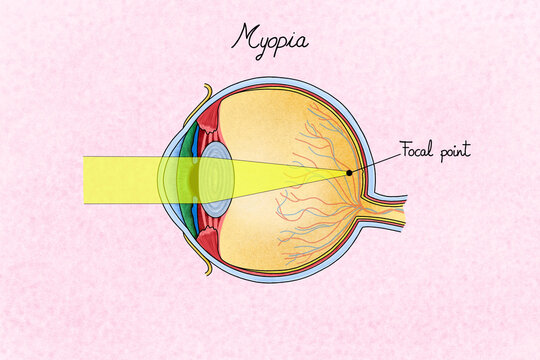 Human eye with myopia. Illustration