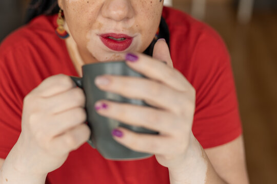 hands of woman with vitiligo anonymous ho