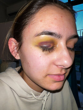 Young woman with black eye